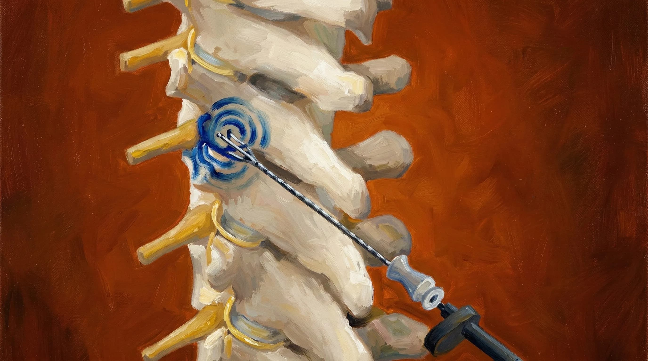 ⚡ Rizotomia de Coluna Torácica por Radiofrequência