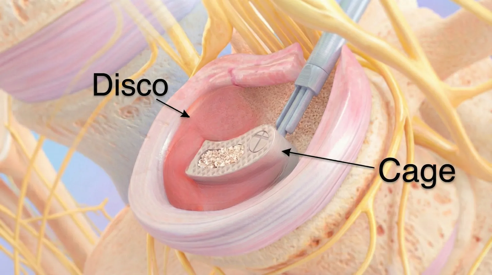 🔩 Artrodese Lombar TLIF (Pela Lateral de Trás)