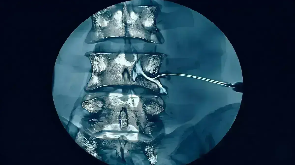 Bloqueio Transforaminal Lombar (BTF)