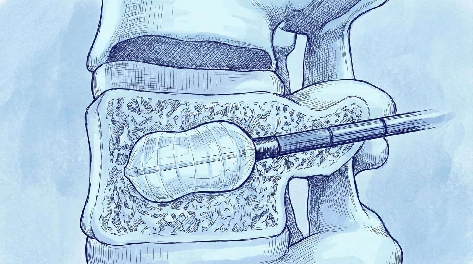 🎈 Cifoplastia por Balão (Fratura Osteoporótica)