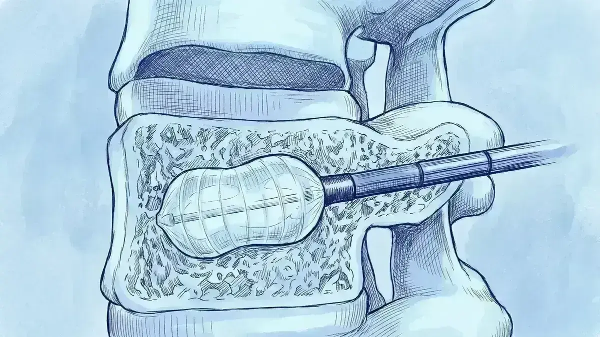 Cifoplastia por Balão (Fratura Osteoporótica)