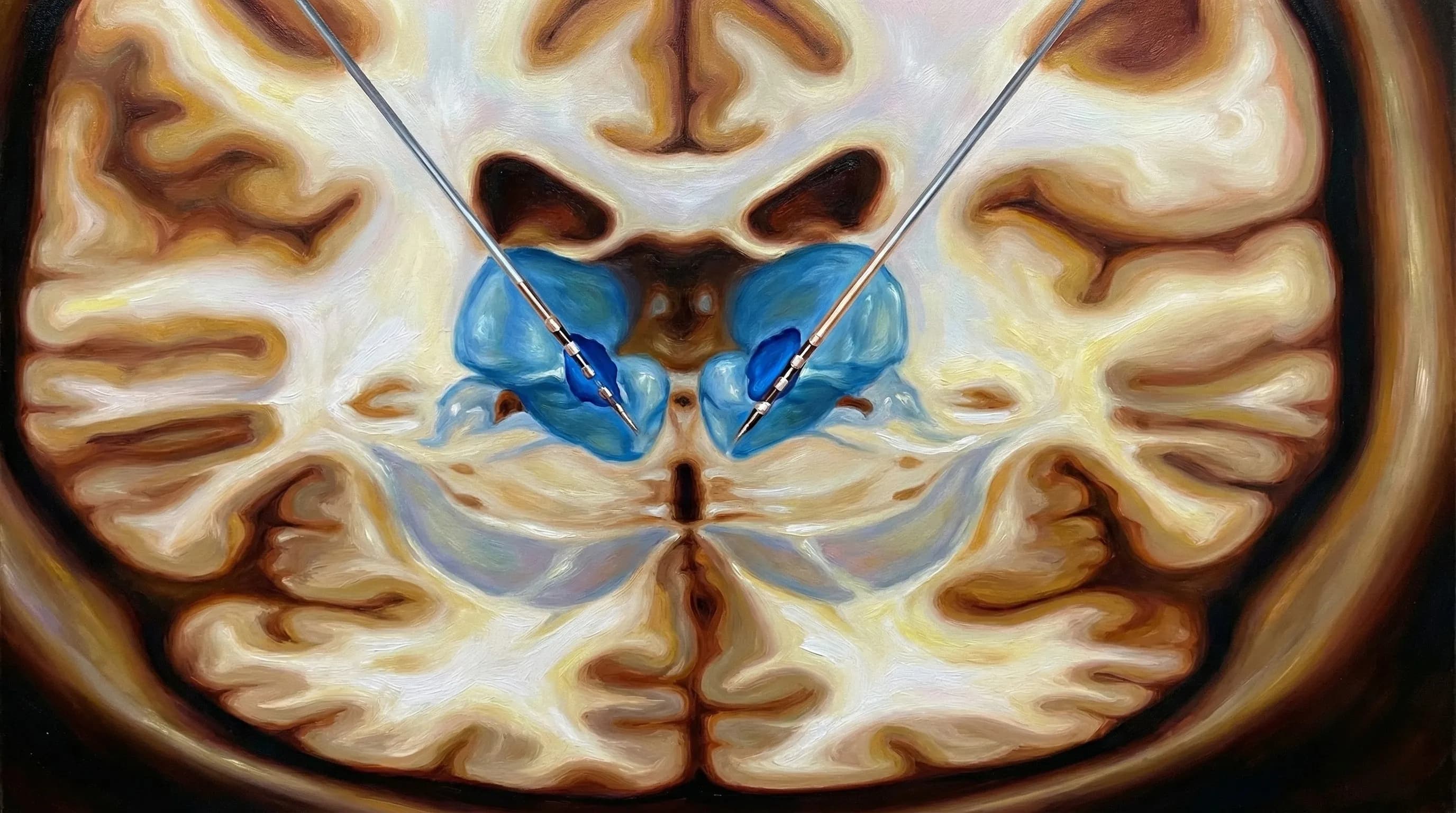 🌟 Implante de Estimulador Cerebral Profundo para Epilepsia (DBS no Tálamo Anterior)