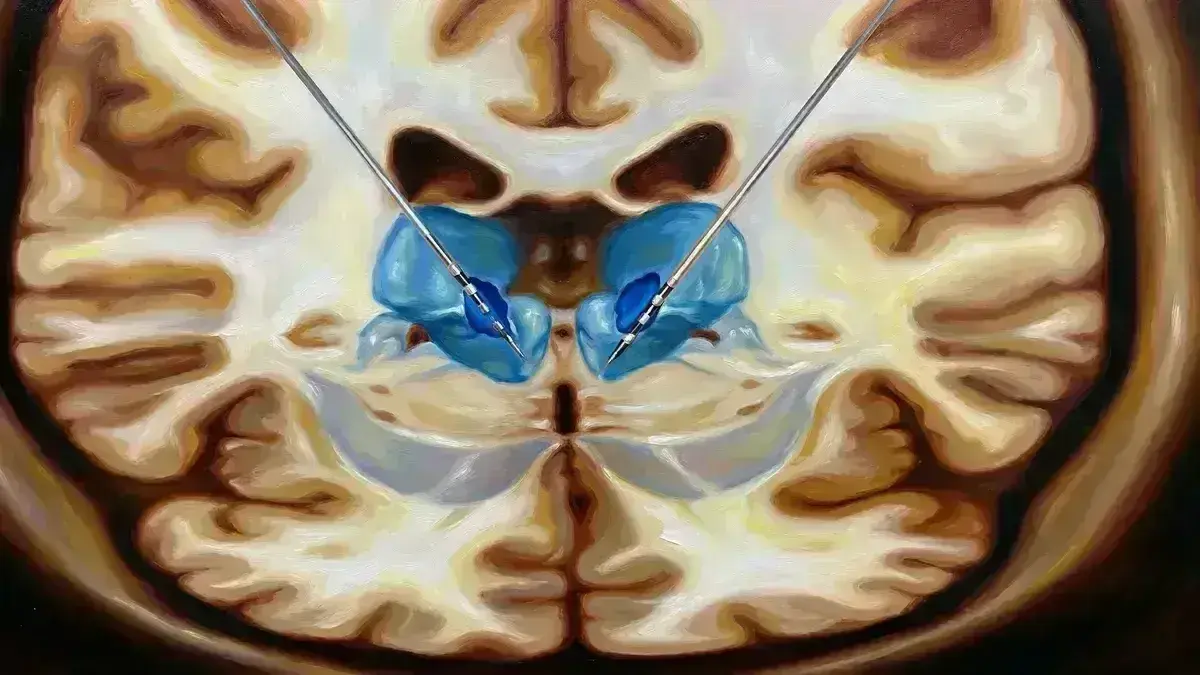 Implante de Estimulador Cerebral Profundo para Epilepsia (DBS no Tálamo Anterior)