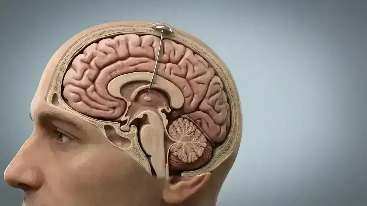 Reservatório de Ommaya (Porta de Acesso ao LCR)