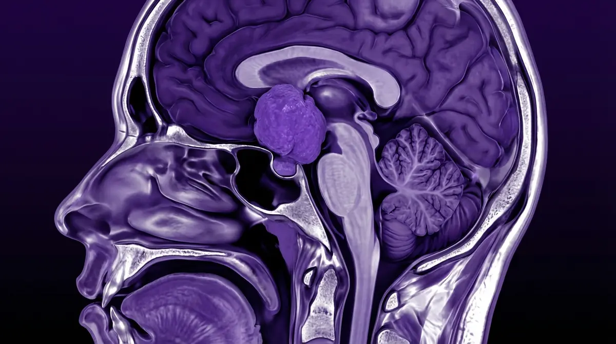 🦴 Ressecção de Cordoma de Clivus