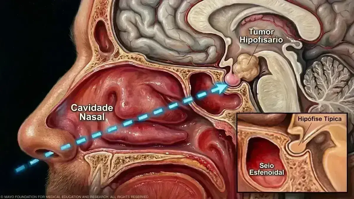 Ressecção de Adenoma Hipofisário Endoscópica