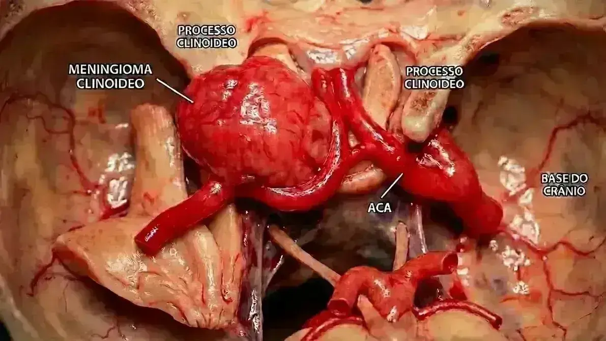 Ressecção de Meningioma do Clinóide Anterior