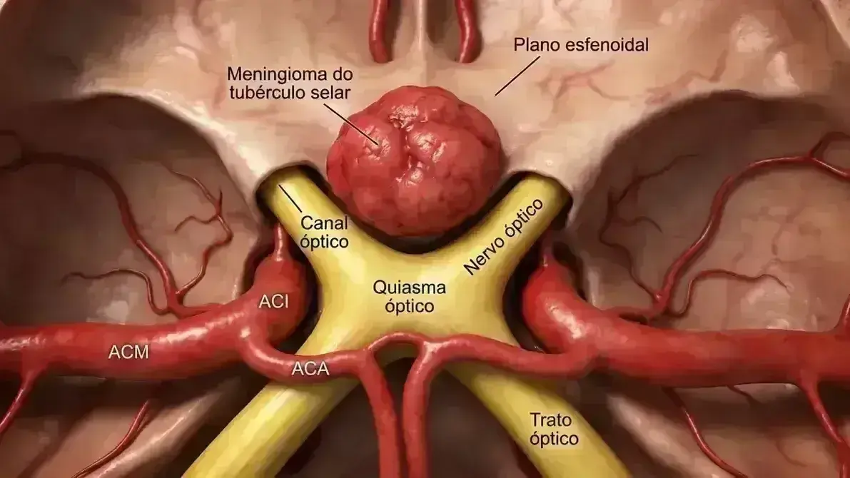 Ressecção de Meningioma do Tubérculo da Sela