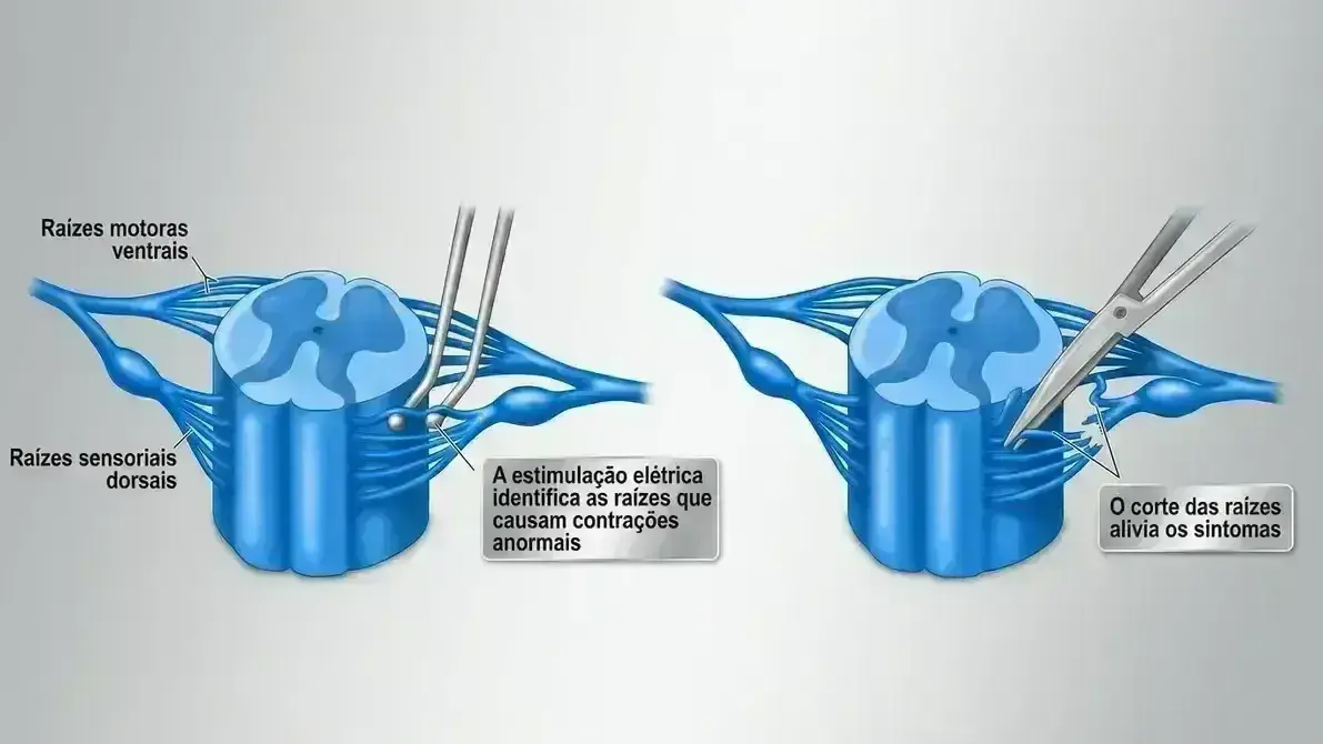 Rizotomia Dorsal Seletiva para Espasticidade