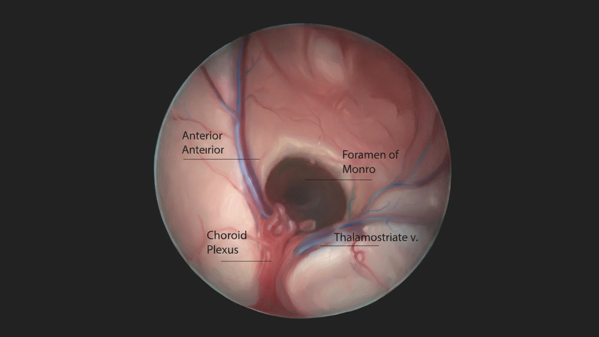 🕳️ Terceiroventriculostomia Endoscópica (TVE)