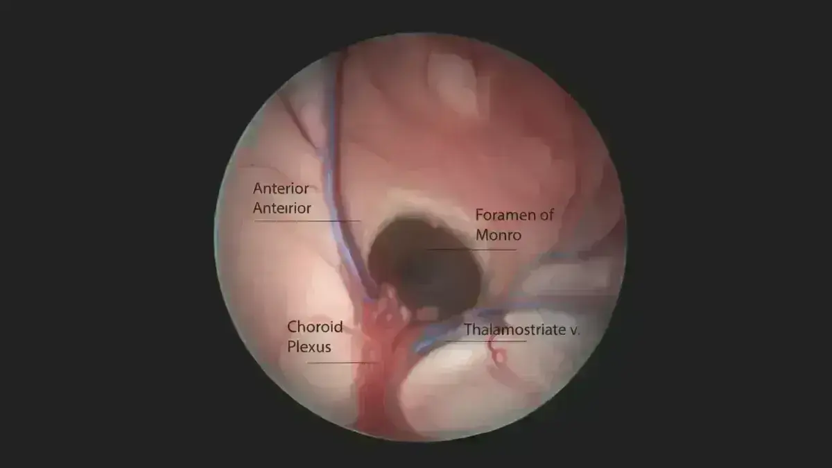 Terceiroventriculostomia Endoscópica (TVE)