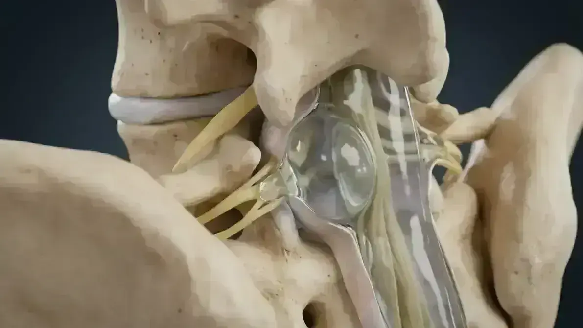 Cisto Sinovial Facetário Lombar