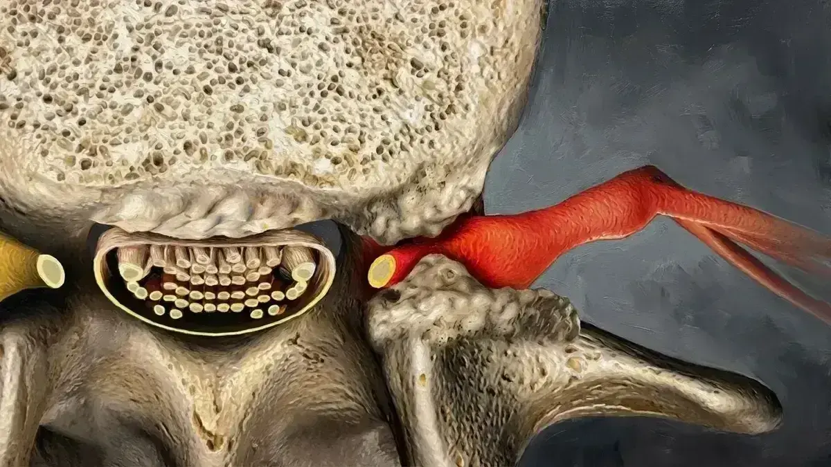 Estenose Foraminal Lombar