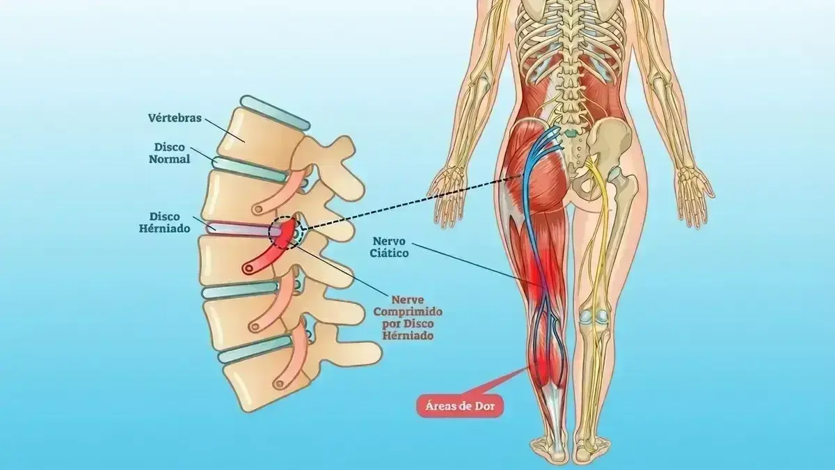 Radiculopatia Lombar