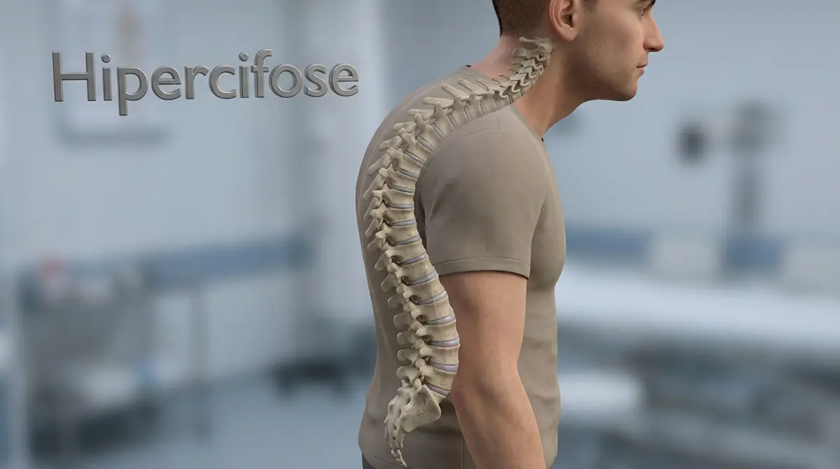 🦴 Cifose de Scheuermann