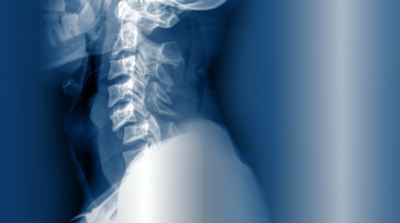 💥 Luxação Cervical Traumática com Compressão Medular
