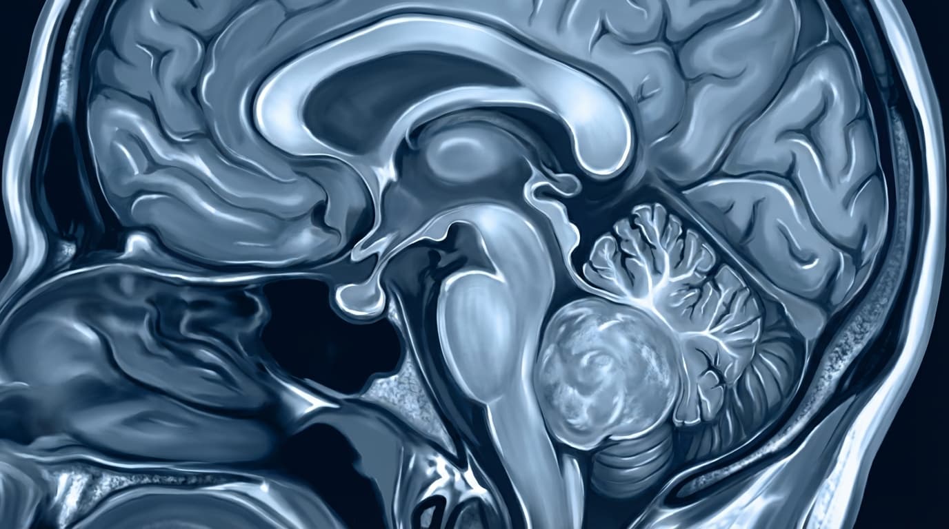 🧠 Meduloblastoma Cerebelar