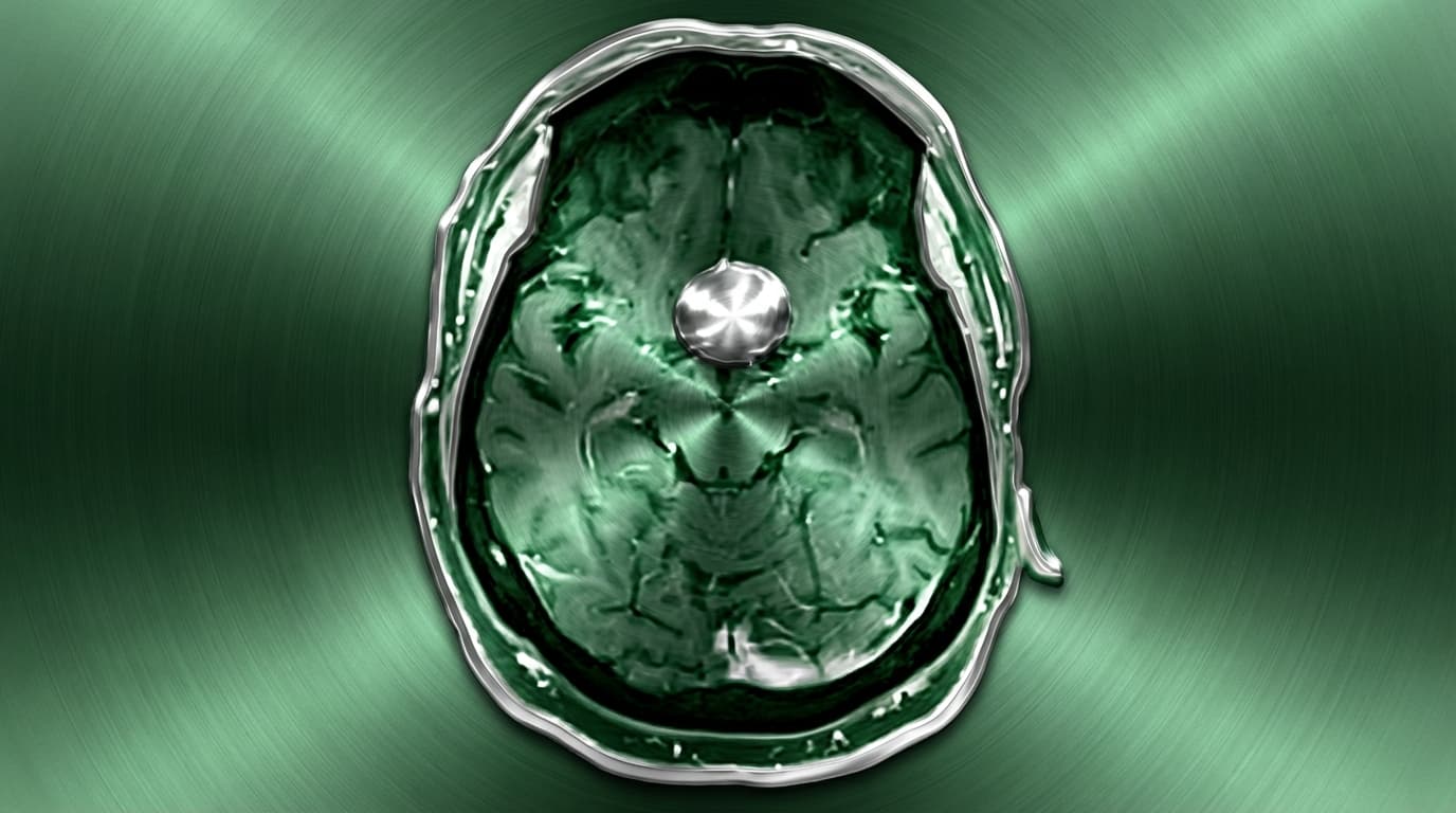 🦴 Meningioma do Tubérculo da Sela