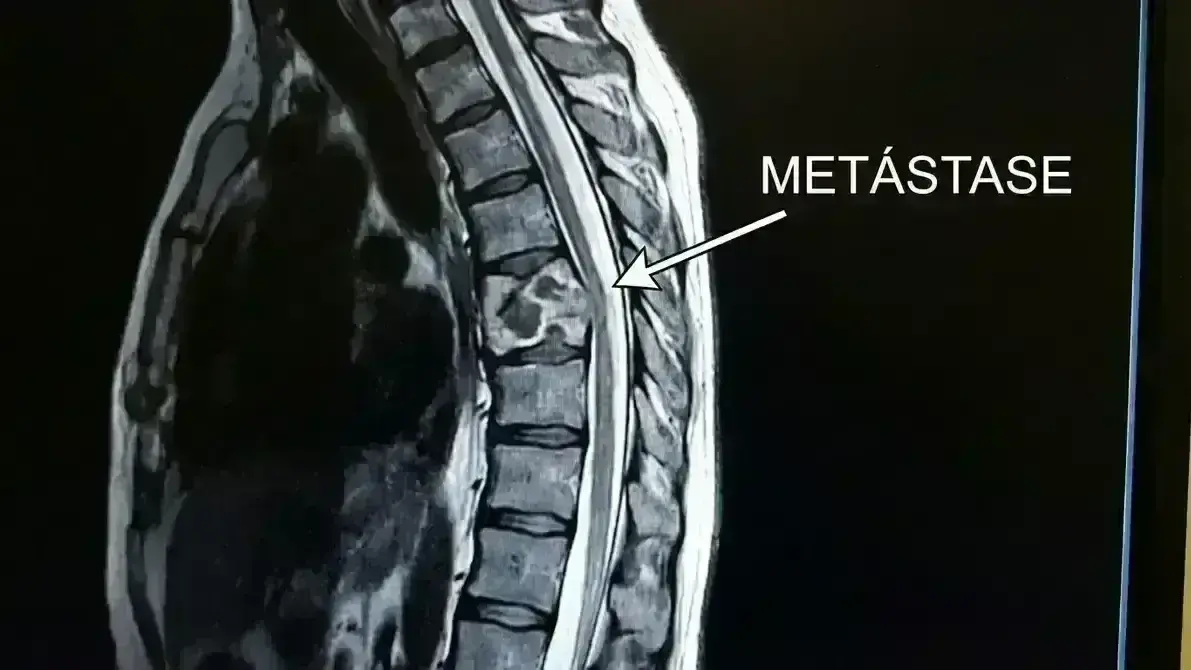 🔥 Dor Oncológica Espinhal