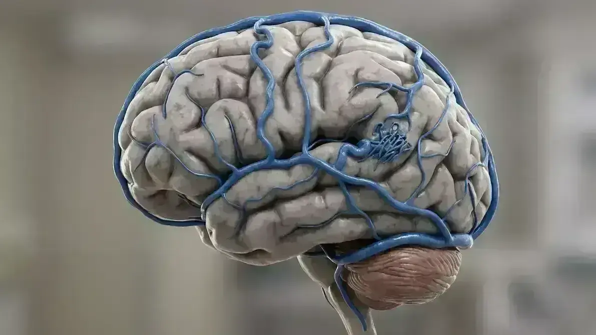 Angioma Venoso Cerebral