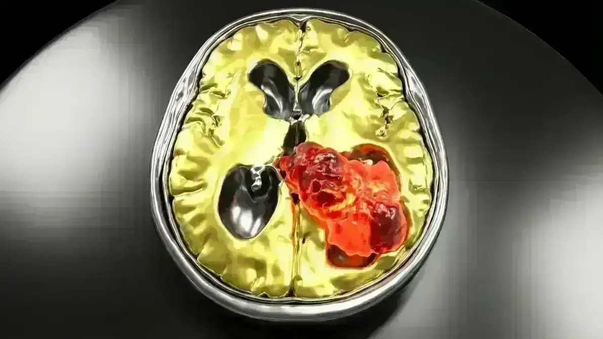 Carcinoma de Plexo Coroide