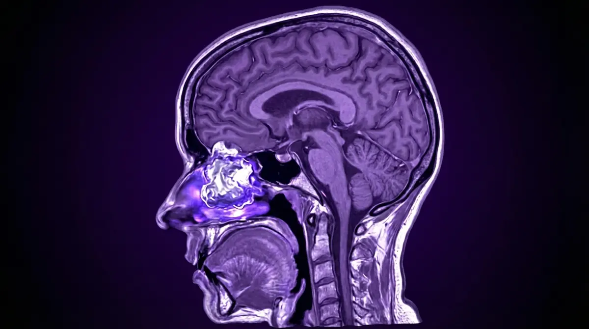 👃 Estesioneuroblastoma