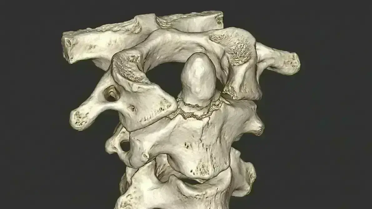 Fratura de Odontoide (C2)