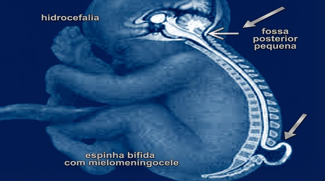 🍼🧠 Malformação de Chiari Tipo II
