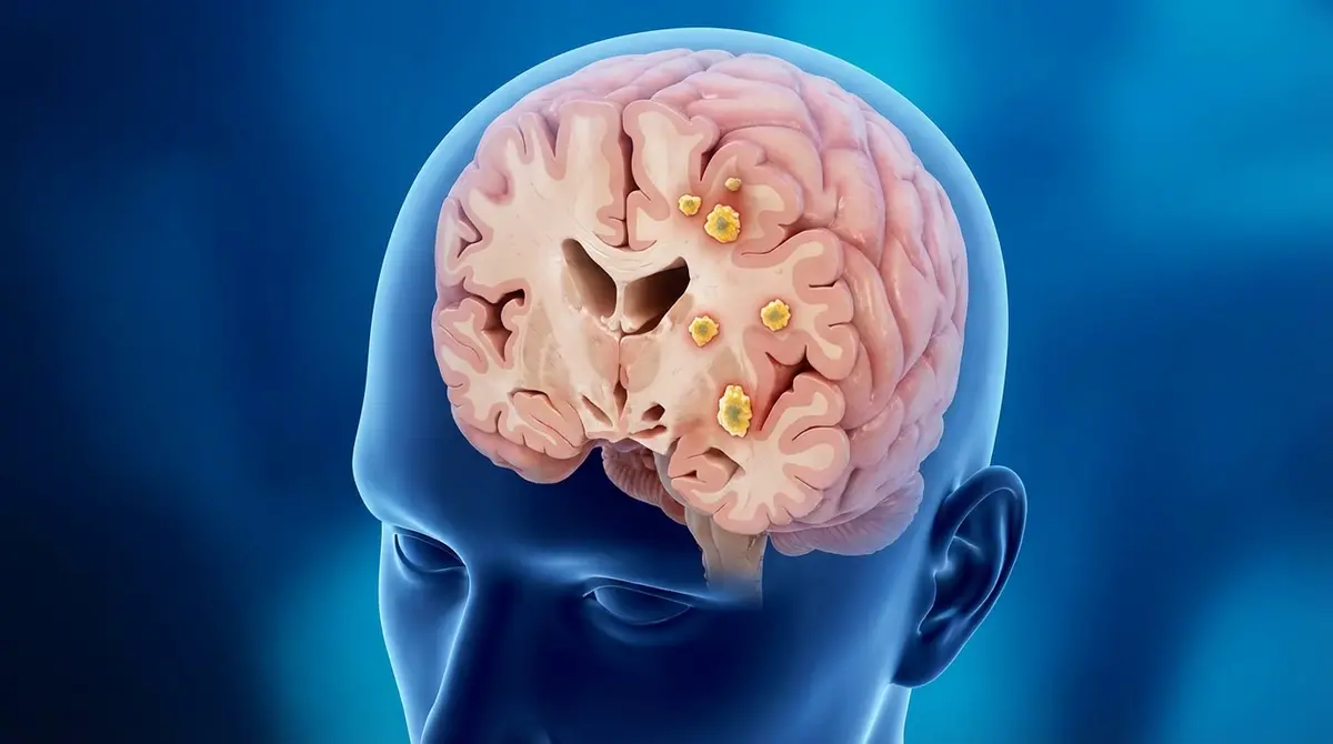 Metástases cerebrais múltiplas