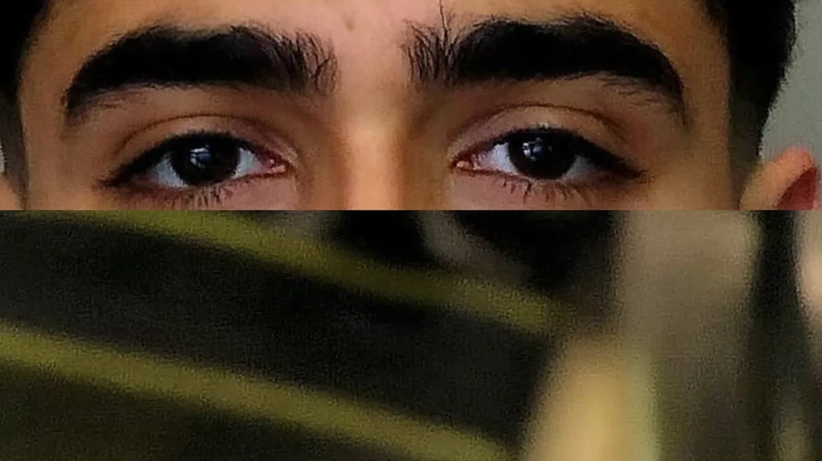 ️ Paralisia Supranuclear Progressiva