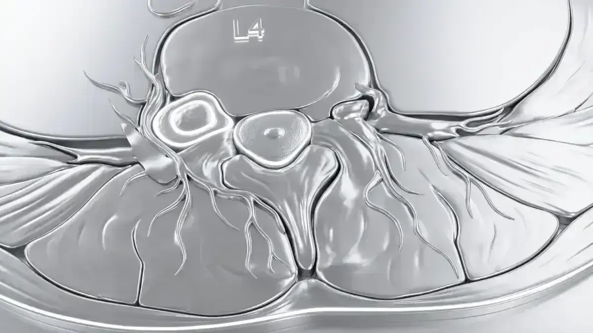 🦴 Schwannoma Espinhal Lombar