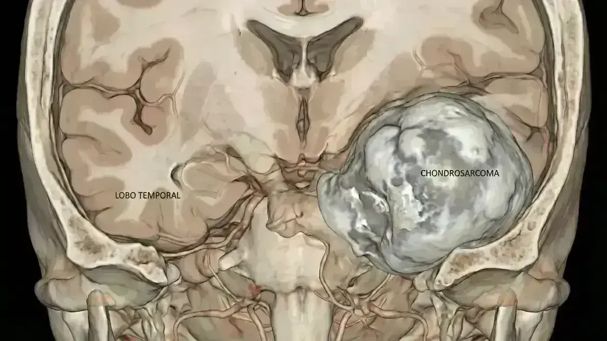 🦴 Condrossarcoma de Base do Crânio