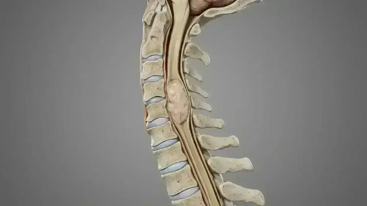🎋 Ependimoma Intramedular Cervical