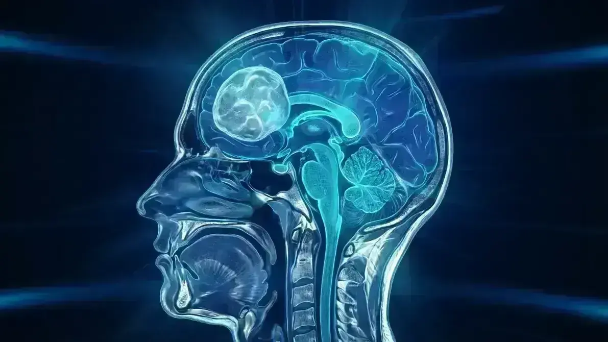 🧬 Linfoma Primário do Sistema Nervoso Central