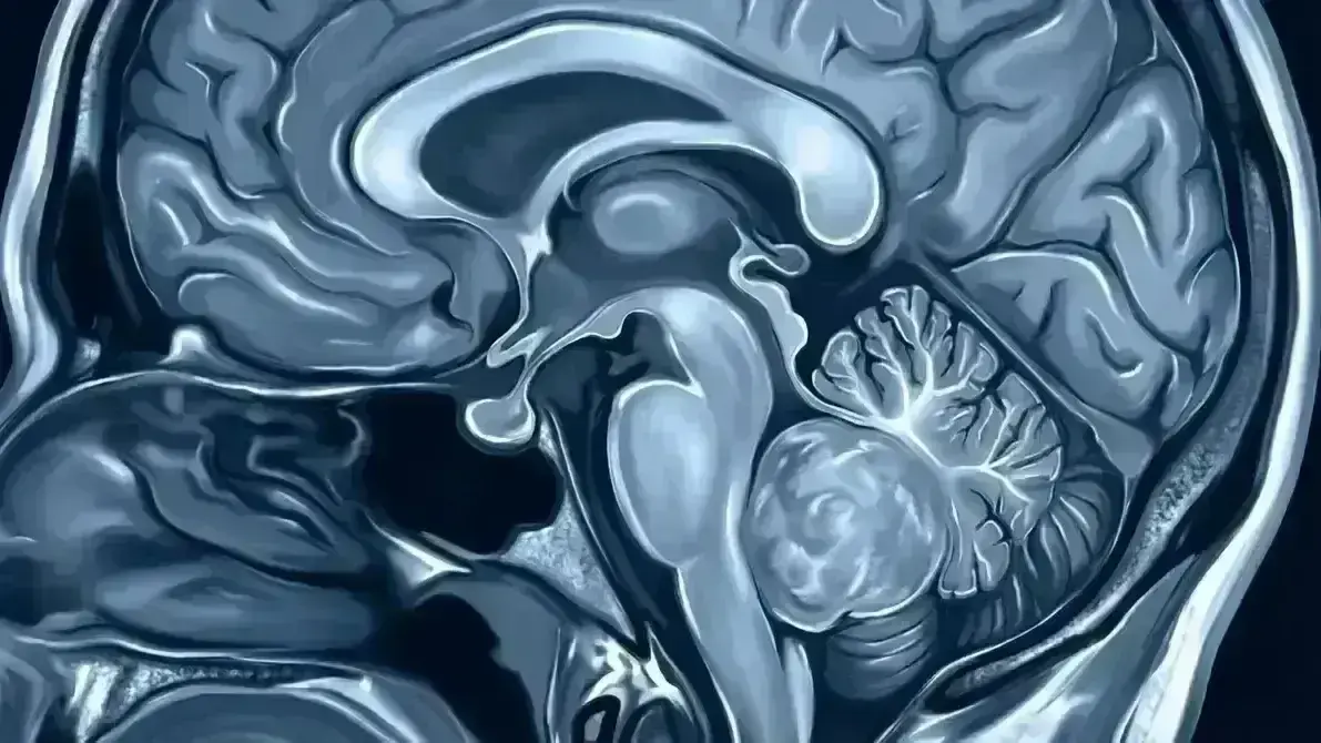 🧠 Meduloblastoma Cerebelar
