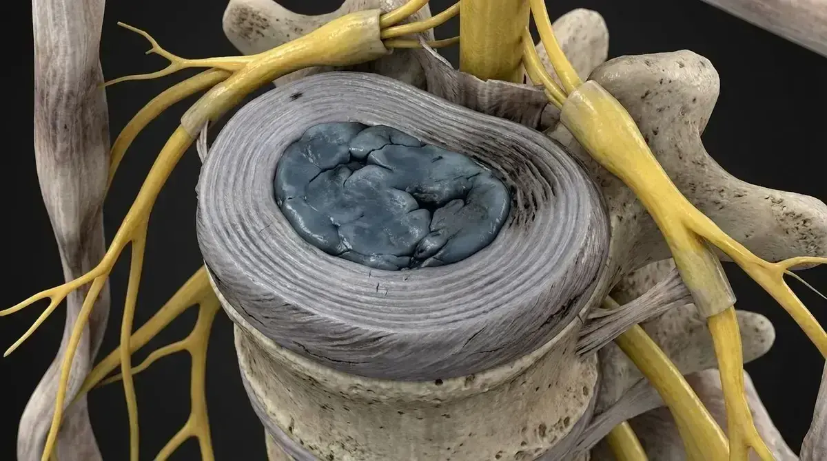 Doença Discal Degenerativa